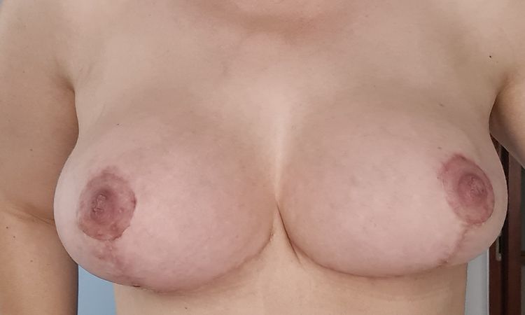Asymetria po mastopeksji z implantami - kiedy można poprawić? - 53849