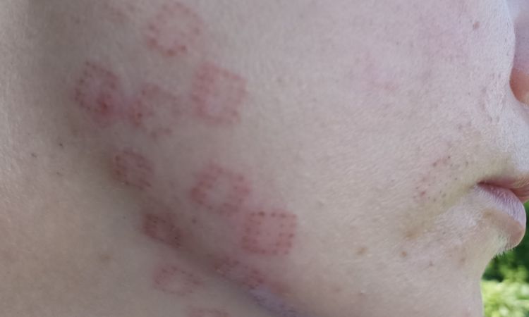 Czy takie ślady po radiofrekfencji mikroigłowej są normalne? - 54126