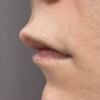 Czy dziubek po powiększaniu ust może sam zniknąć?