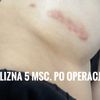 Co można zrobić z rozlaną i wypukłą blizną po powiększaniu piersi?