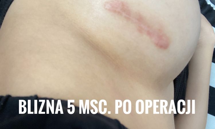 Co można zrobić z rozlaną i wypukłą blizną po powiększaniu piersi? - 56414