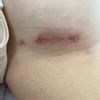Co można zrobić z rozlaną i wypukłą blizną po powiększaniu piersi?