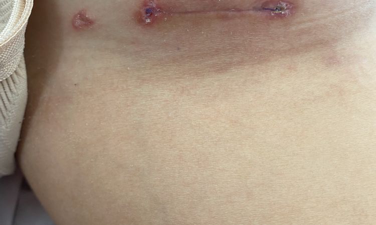 Co można zrobić z rozlaną i wypukłą blizną po powiększaniu piersi? - 56415