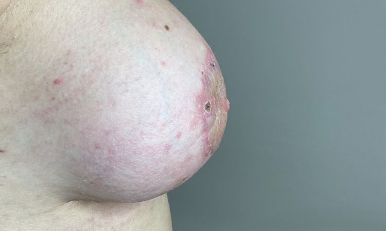 Asymetria piersi po powiększaniu i uniesieniu - 57151