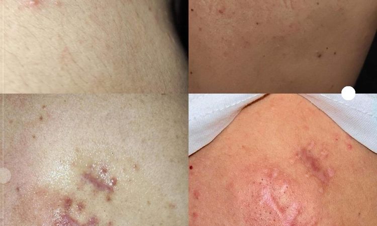 Jak sobie poradzić z zmianami podskórnymi po zabiegu usuwania kaszaka? - 58259
