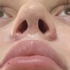 Czy asymetria dziurek zostanie po operacji nosa?