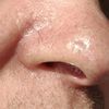 Czy można usunąć ubytek - wgłębienie na nosie?
