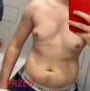 Czy możliwa jest liposukcja po ginekomastii?