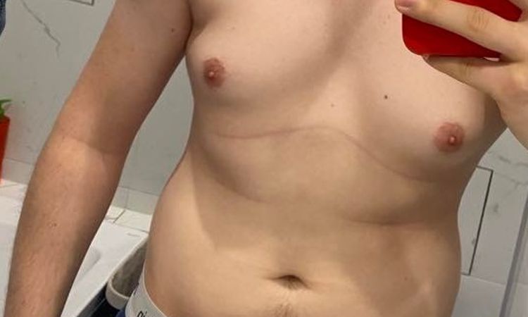 Czy możliwa jest liposukcja po ginekomastii? - 58721