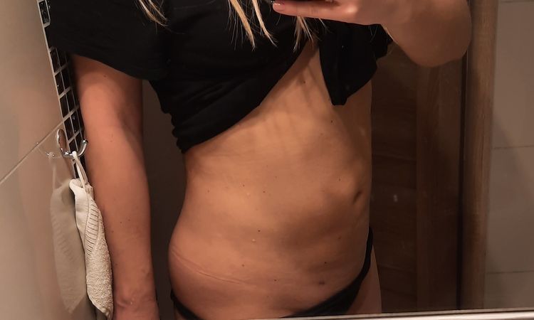 Jaką metodą najlejpiej usunąć nierówności po liposukcji? - 58918