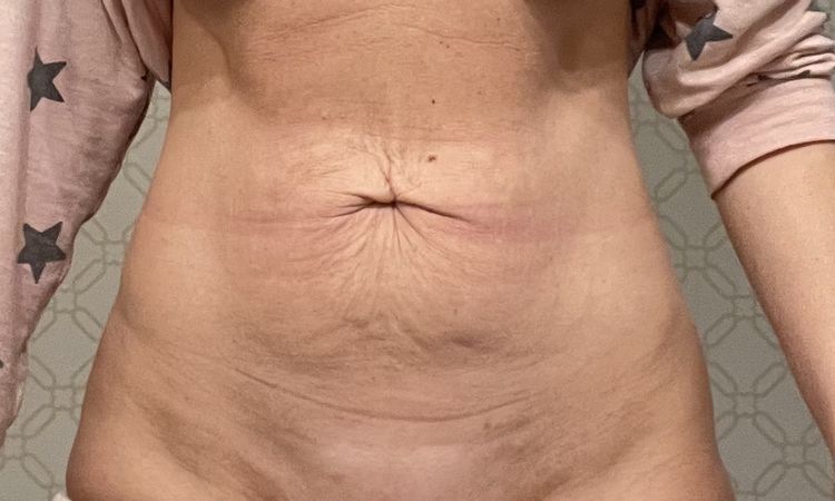 Czy możliwa jest abdominoplastyka lub plastyka pępka? - 59160