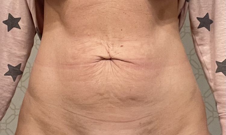 Czy możliwa jest abdominoplastyka lub plastyka pępka? - 59161