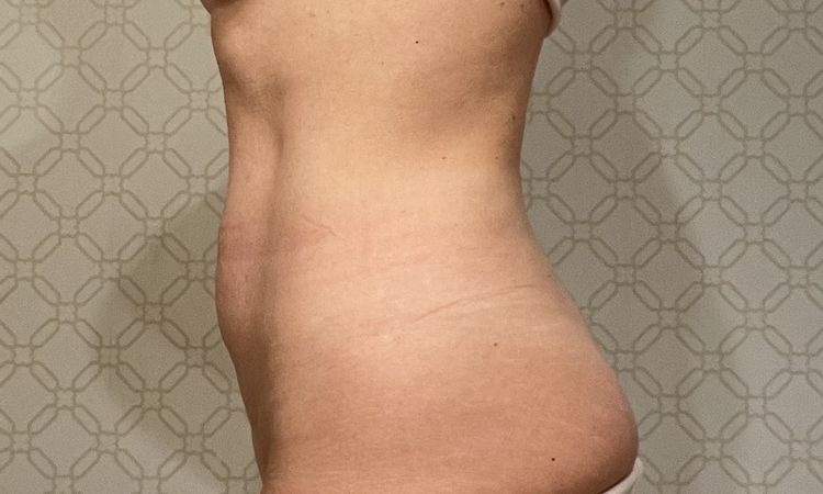 Czy możliwa jest abdominoplastyka lub plastyka pępka? - 59162