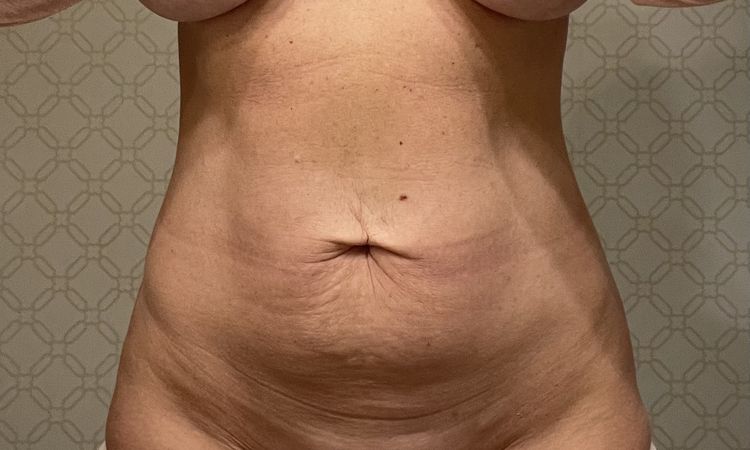 Czy możliwa jest abdominoplastyka lub plastyka pępka? - 59163