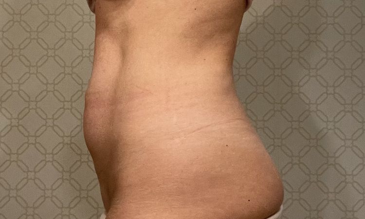 Czy możliwa jest abdominoplastyka lub plastyka pępka? - 59164
