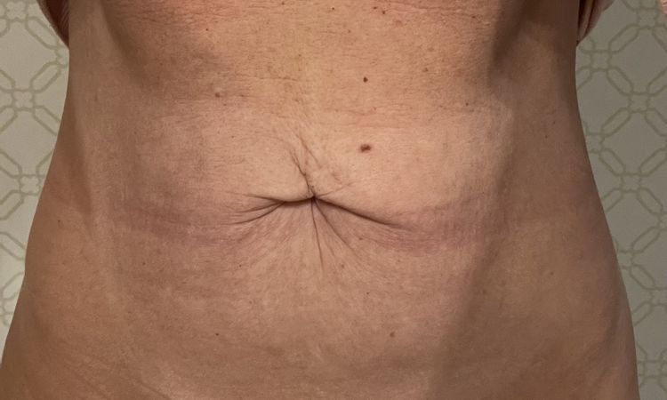 Czy możliwa jest abdominoplastyka lub plastyka pępka? - 59165