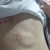 Czy można poddać się zabiegom po wymianie zastawki serca?