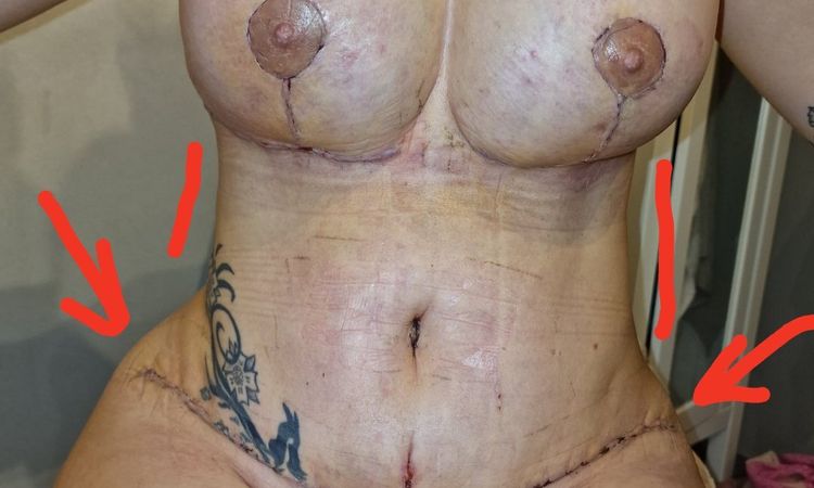Niesymetryczna liposukcja i plastyka brzucha. - 60456