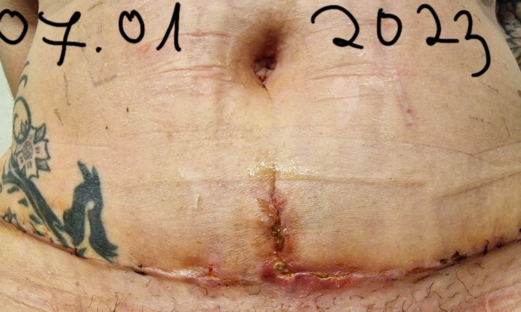 Jak poradzić sobie z ropiejącą raną po plastyce brzucha? - 60757