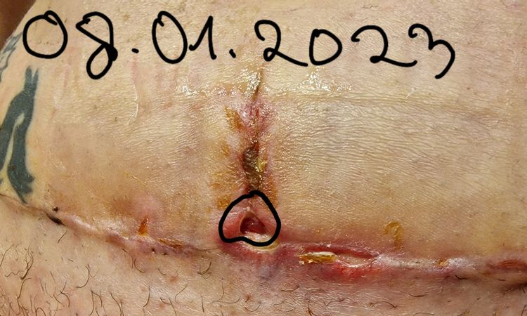 Jak poradzić sobie z ropiejącą raną po plastyce brzucha? - 60758