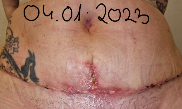 Jak poradzić sobie z ropiejącą raną po plastyce brzucha? - 60759