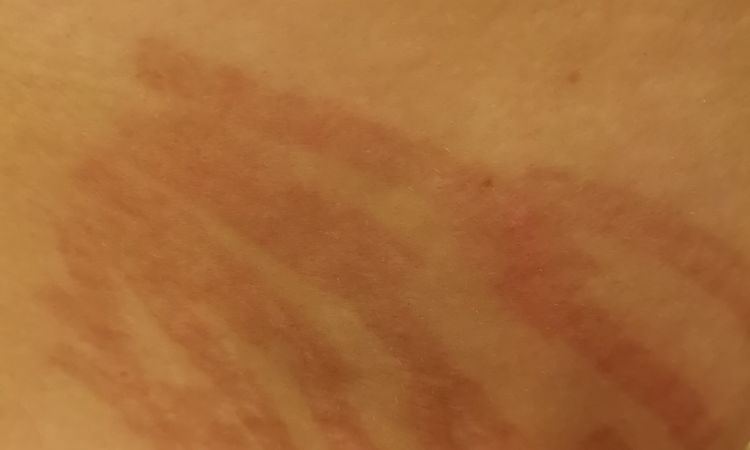 Jak usunąć ciemne blizny po zabiegu usuwania rozstępów? - 63114