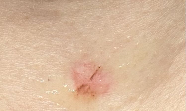 Jak długo mogą utrzymywać się powikłania po usuwaniu laserowym brodawki? - 64420