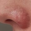 Czy możliwe jest usunięcie chrząstki wszczepionej podczas operacji nosa?