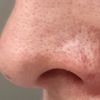 Czy możliwe jest usunięcie chrząstki wszczepionej podczas operacji nosa?
