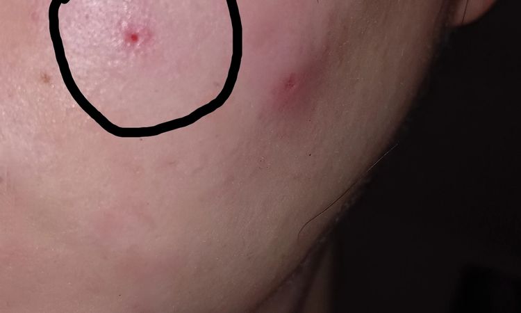 Jak pozbyć się blizny po wyprysku? - 64448