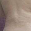Nierówności po zabiegu liposukcji vaser lipo hd 360