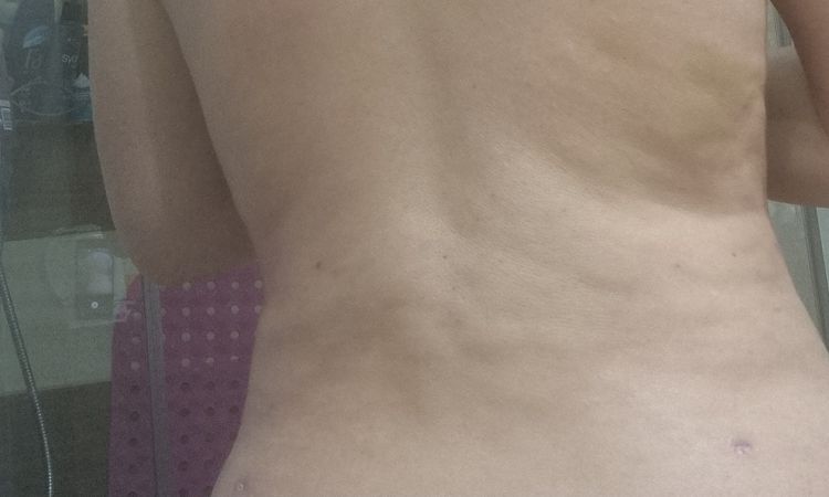 Nierówności po zabiegu liposukcji vaser lipo hd 360 - 64818