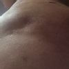 Nierówności po zabiegu liposukcji vaser lipo hd 360