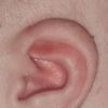 Kiedy i jak można zadziałać z asymetrią uszu u niemowlaka? - 64902