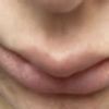 Czy możliwe że kwas nie przyjmuje się jednakowo na całej długości ust?
