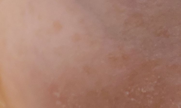 Jak poza laserem można uporać się z żyłami pod oczami? - 65929