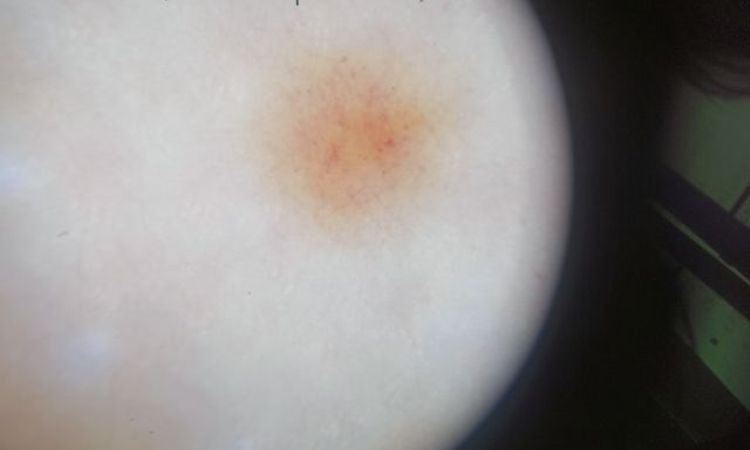 Znamie atypowe czy czerniak? - 66462
