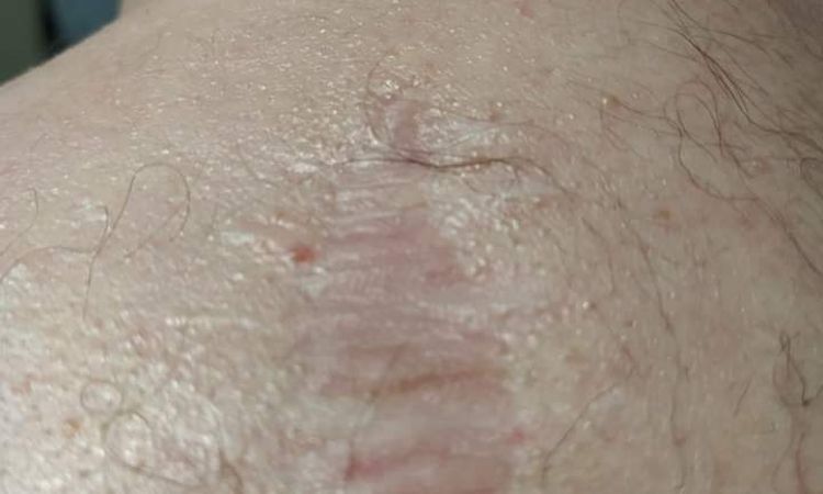 Co zrobić z blizną pooperacyjną- zmiana nowotworowa - 69465