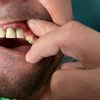 Zęby -pomoc przy wyborze metody uzupełnienia uzębienia - 69870