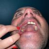 Zęby -pomoc przy wyborze metody uzupełnienia uzębienia - 69873