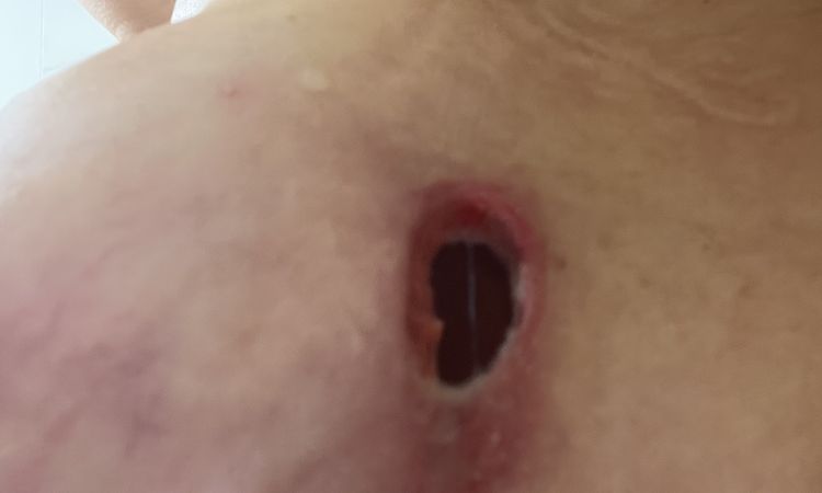 Infekcja piersi i usunięcie implantów - 71611
