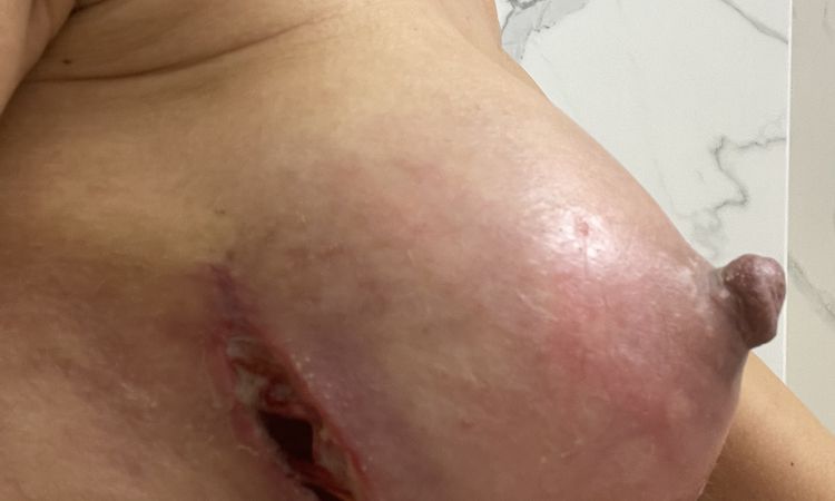 Infekcja piersi i usunięcie implantów - 71612