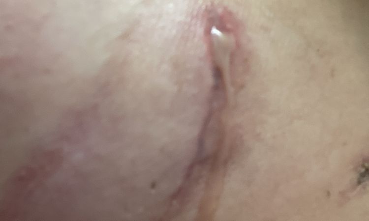 Infekcja piersi i usunięcie implantów - 71614