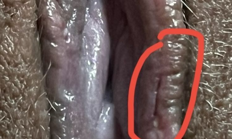 Infekcja intymna labioplastyka diclac - 71645