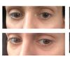Jak najskuteczniej poprawić skutki źle wykonanej RF mikroigłowej - okolice oczu - 72084