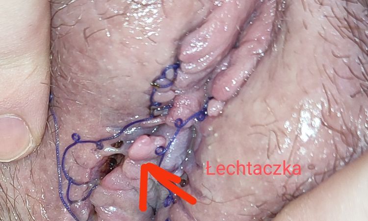 Niepokojący wygląd po Labioplastyce - 72284