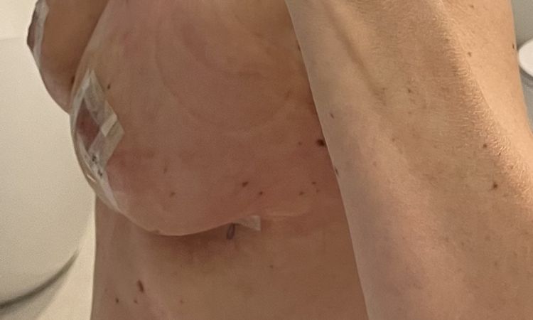 Kształt i wysokość implantu - 72420