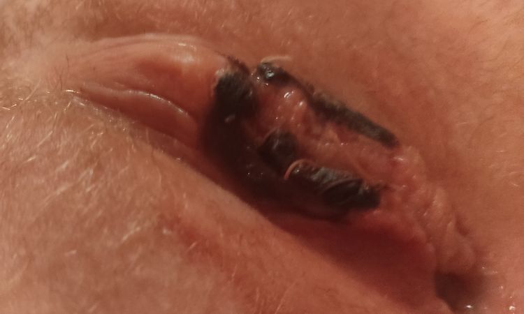 Rozejście się rany po labioplastyce- czarna warga - 72582
