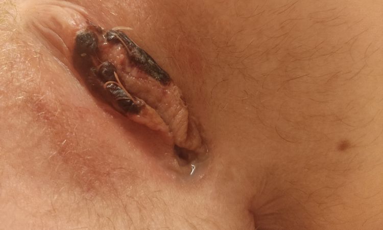 Rozejście się rany po labioplastyce- czarna warga - 72583
