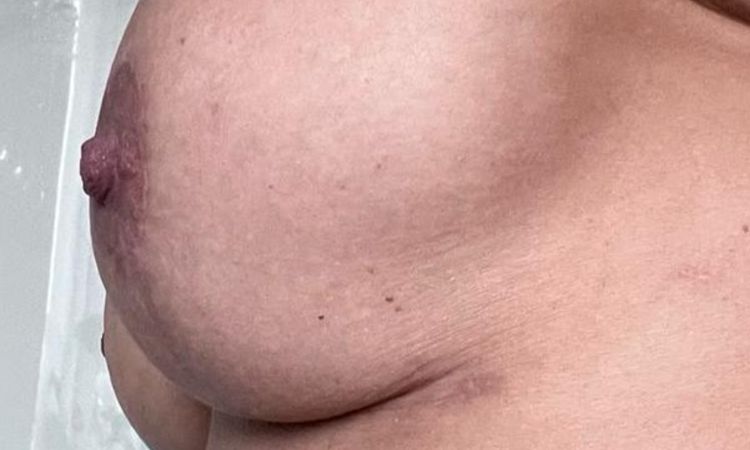 Opadające piersi po liftingu. implant jest wysoko a dół całkowicie luzny - 72801